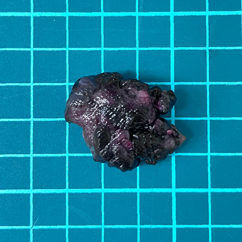 切下來的黑色素細胞瘤團塊