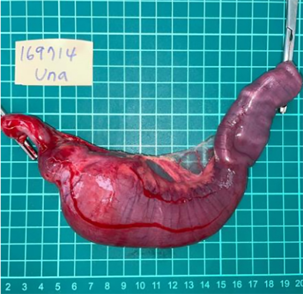 採樣報告證實為惡性腸腺癌Adenocarcinoma，伴隨嚴重、潰瘍性腸炎。