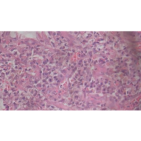 採樣報告證實為惡性腸腺癌Adenocarcinoma，伴隨嚴重、潰瘍性腸炎。