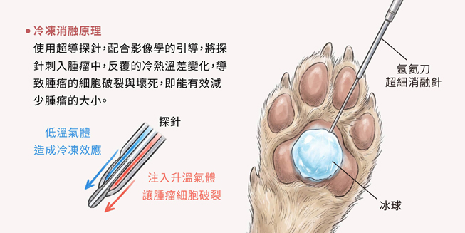 氬氦刀 / 冷凍消融治療-原理介紹