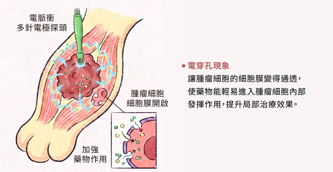 電脈衝化療 (ECT) 治療原理介紹 電脈衝化療 (ECT) 治療原理介紹