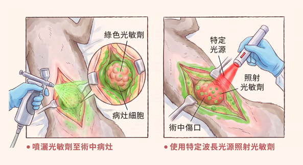 光動力治療 (PDT) 原理介紹